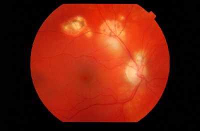 Toxoplasmosis Unilateral uveitis Active focus of chorioretinitis usually adjacent to an old scar AC