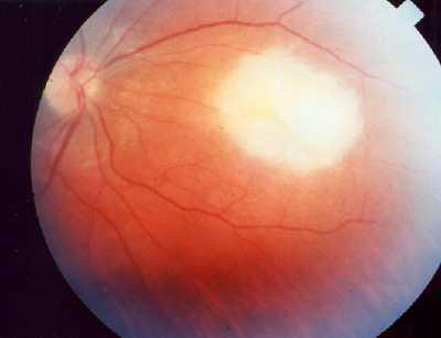 Candida Unilateral uveitis Single (or multiple) focus of chorioretinitis with no adjacent scar May have vitreous puffballs or