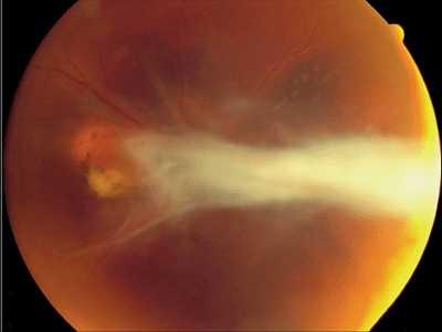 Toxocara Uncommon cause of unilateral uveitis and focal chorioretinitis Mainly