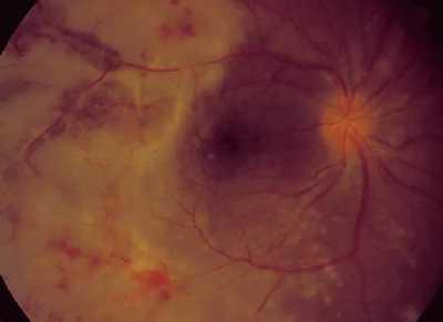 Acute retinal necrosis Rapidly progressive peripheral retinitis Well patients VZV