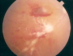 Eale's disease Occlusive retinal vasculitis