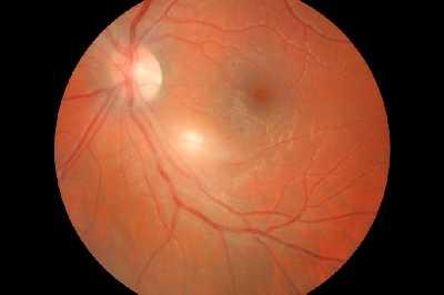 Retinal vasculitis secondary to retinal