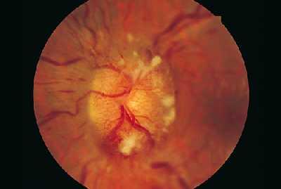 Optic papillitis Uveitis Inflammation centred on the optic nerve Note: mild disc swelling