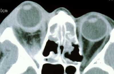Posterior scleritis