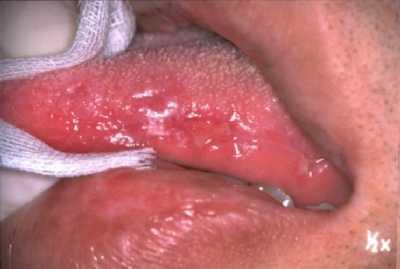 Behcet s Recurrent oral ulceration plus Two of