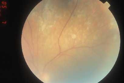Primary ocular lymphoma Elderly patients (>50 yo) Persistent and progressive and treatment