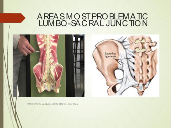 AREAS MOST PROBLEMATIC LUMBO-SACRAL JUNCTION SACRAL