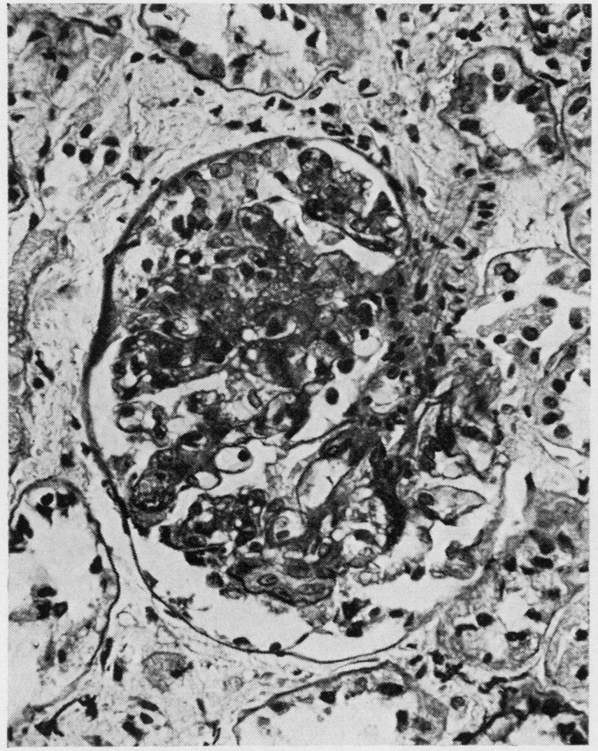 119 FIG. 1. Proliferative glomerulonephritis with secondary membranous change. P.A.S.