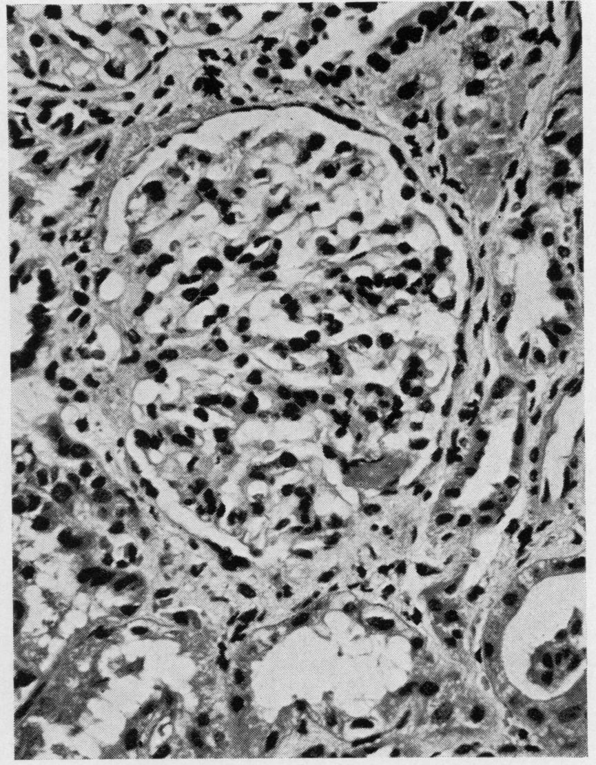 FIG. 8. 121 FIG. 7. Minimal lesion. Note focal area of sclerosis in glomerulus.