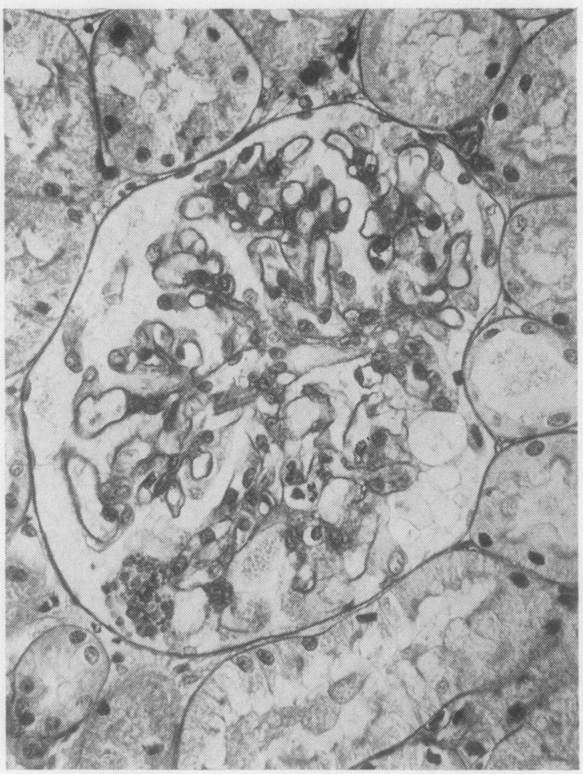 However, histology revealed typical proliferative lesions in the glomerular tufts of one case in areas of otherwise normal renal cortex.