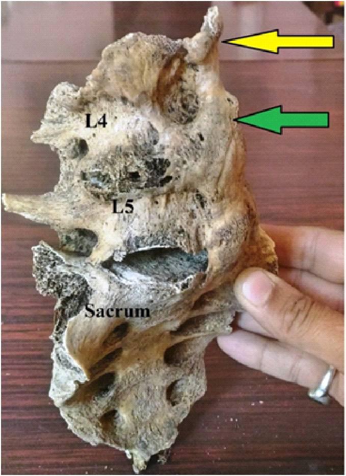 5: Showing segmental type of ossification (Yellow arrow) of anterior longitudinal ligament at L1, L2 level. It was observed that out of 50 sets of dry human vertebral columns 8 (16.