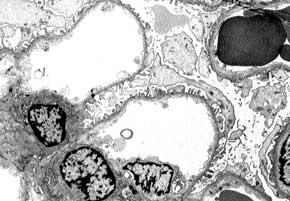 Heredofamilial and Congenital Glomerular Disorders 3.3 FIGURE 3-4 Thin basement membrane nephropathy.