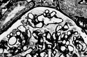 Glomeruli with thin basement membranes many also occur in persons who do not have a family history of renal disease but who have hematuria, low-grade proteinuria, or both.