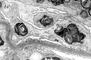 Here, the electron microscopic abnormalities are diagnostic; all or virtually all glomerular basement membranes are markedly thin (<200 nm in adults) without other features such as splitting,