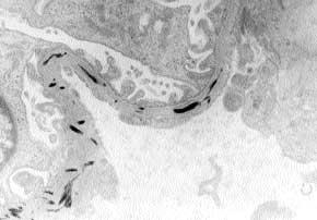 3.4 Glomerulonephritis and Vasculitis FIGURE 3-6 Electron microscopy of nail-patella syndrome.