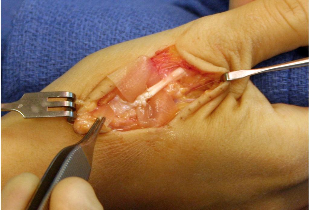and surgical incision [Figure 6]. The wound was closed and a sterile dressing, including plaster splint, was applied. Figure 4.