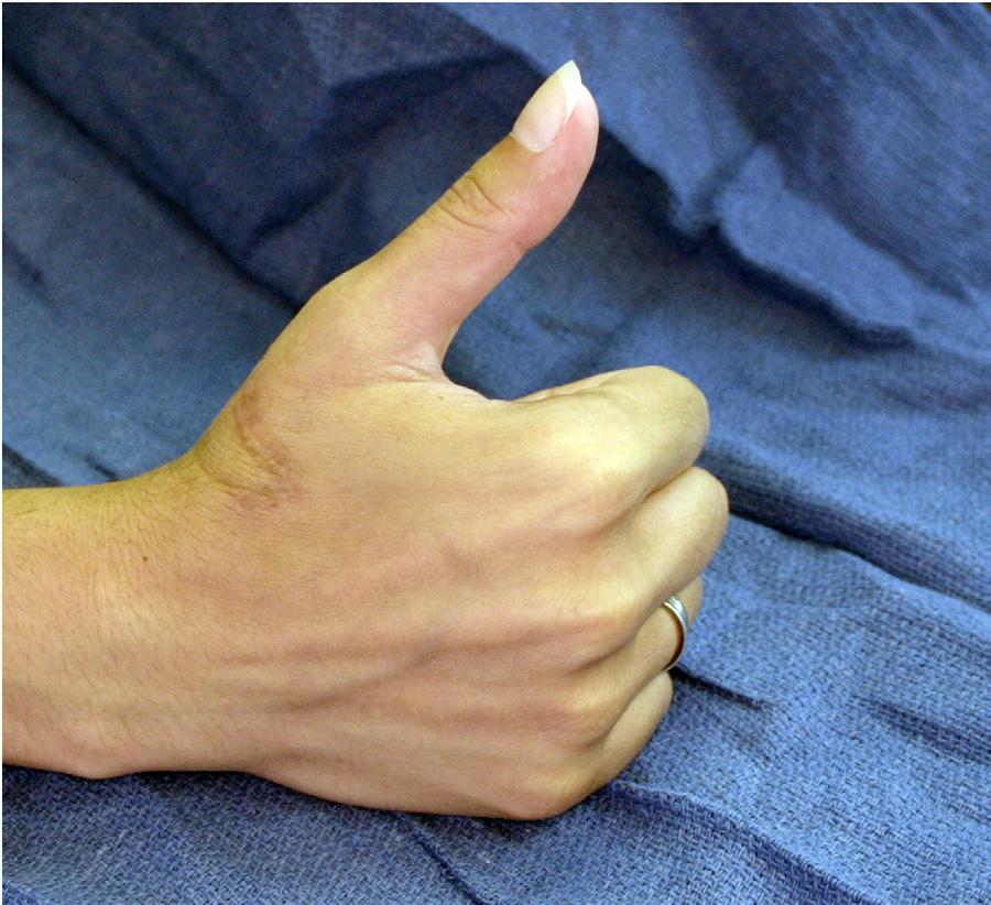 Postoperative Course: Skin sutures were removed after 2 weeks; however, the patient was kept in a splint or cast for 6 weeks with only minimal wiggling of the thumb allowed.
