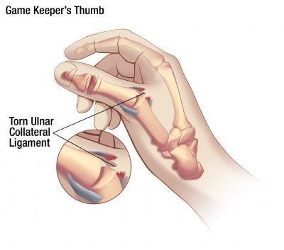 Ulnar Collateral Ligament Injuries of the Thumb Game Keeper s Thumb