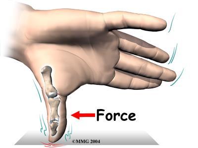 Any extreme force that pulls the thumb away from the palm of the hand can damage the ligaments.