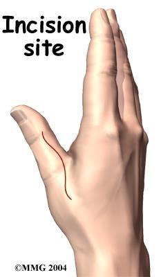 Treatment What can be done for the condition? The MCP joint needs to be stable for the thumb to be strong enough to grasp objects.