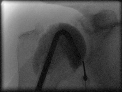 Synovial Biopsy Technique Performed by MSK Radiologist in fluoroscopy suite Patient positioned supine Sterile technique (disinfect skin, drape) 1% Xylocaine infiltrated at two sites 18-G