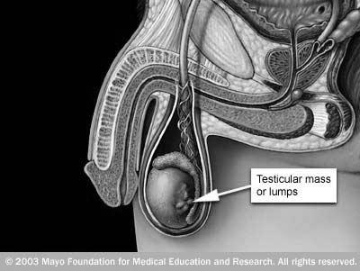 Testicular cancer is highly treatable, even when cancer has spread beyond the testicle.