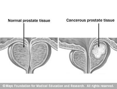 Clinical manifestations of renal cancer are very vague Flank pain Gross hematuria Palpable renal mass Prostate and Testicular cancer Prostate Cancer Prostate cancer is the most common non-skin