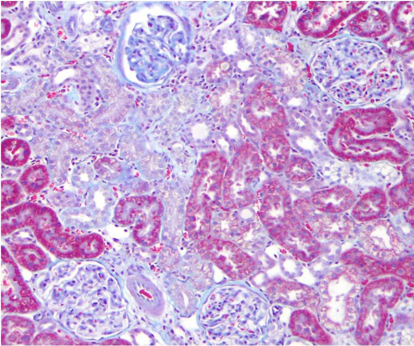 a Fibrosis and Nox2 in