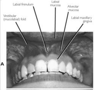 17 Retromolar Gingiva (Retromolar Trigone) This is the attached mucosa overlying the ascending ramus of the