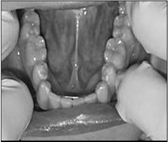 Floor of the Mouth This is a semilunar space over the myelohyoid and hypoglossus muscles, extending from the