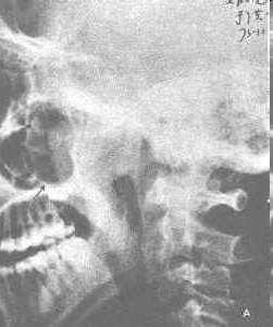 Investigations Plain x-ray: View of the sinuses may demonstrate nasopharyngeal polyp.