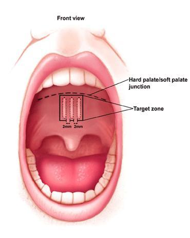 Movements of the Soft Palate The pharyngeal isthmus (the communicating channel between the nasal and oral parts of the pharynx) is closed by raising the soft palate.