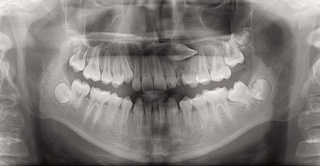 IJOI 39 iaoi CASE REPORT Simplified Open-window Technique for a Horizontally Impacted Maxillary Canine with a Dilacerated Root Introduction A left maxillary canine with a dilacerated root is