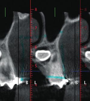 9: The orientation of the impaction and roots of adjacent teeth are visualized on a CBCT image.