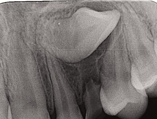 7: An axial slice along the long axis of the impaction shows it is located near the roots of