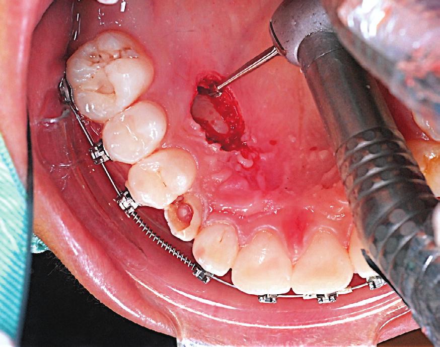 14: All bone covering the crown of the impaction is carefully removed down to the level of the CEJ. Avoid directly contacting the tooth with the bur. (CEJ).