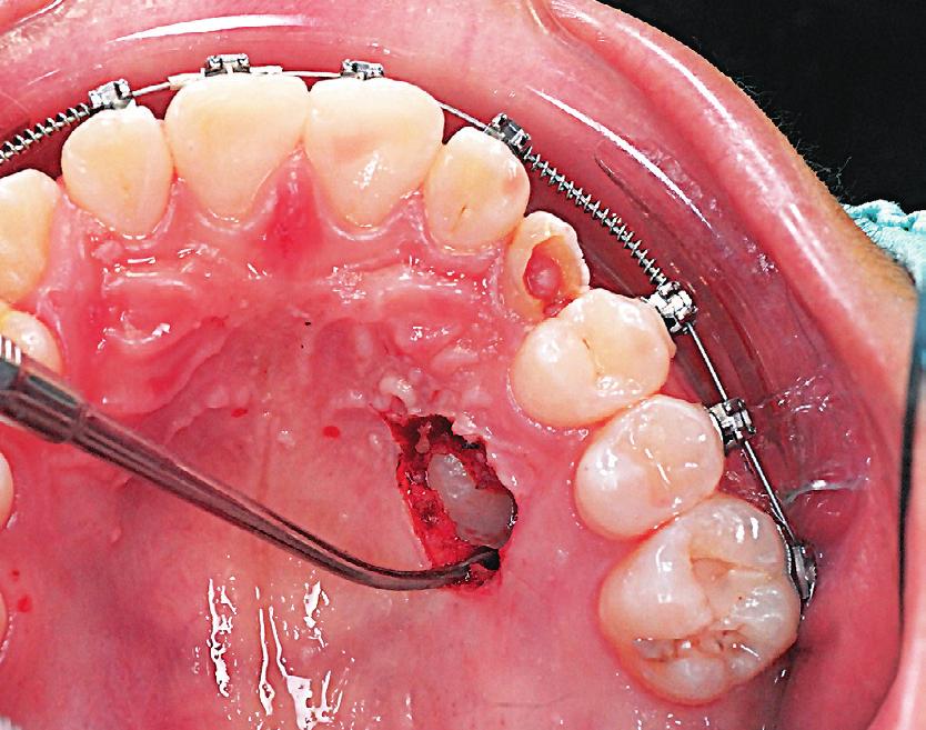 Be cautious with the ESU controls localized bleeding by cauterizing bur near the CEJ to avoid injuring the tooth. vessels and coagulating blood.