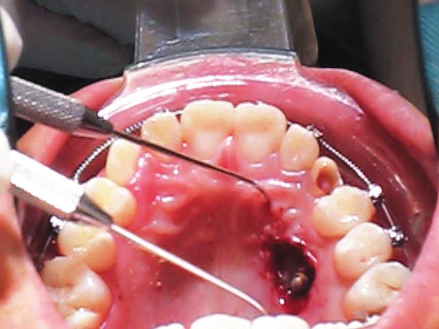 18: Traction is applied with a power chain to upright the canine, and a coil spring is used to open space in the arch for the impaction. A miniscrew is inserted mesial to the impaction.