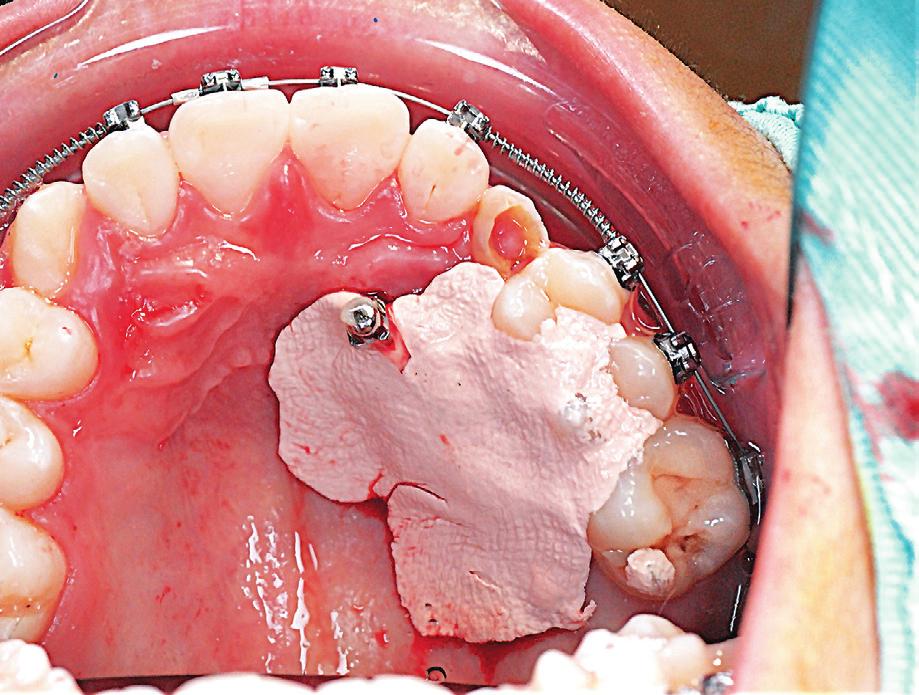 IJOI 39 iaoi CASE REPORT Healing mucosa grows ~1mm/day which is much faster than a tooth erupts. The dressing is essential for maintaining the patency of the window until the tooth erupts through it.