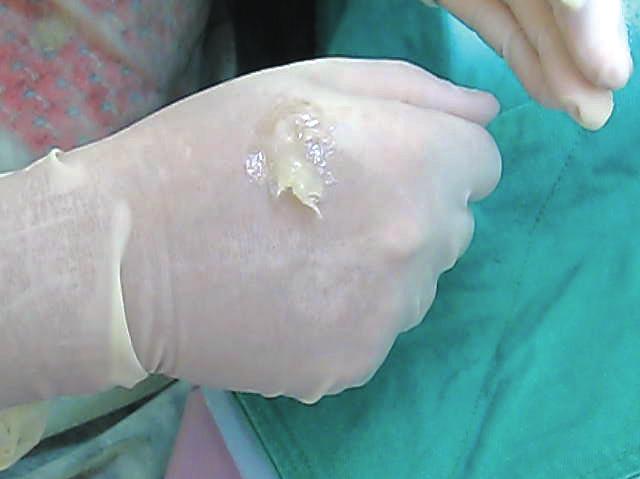 COE-PAK Application Coat glove finger tips with petroleum jelly from the back of the glove (Fig. 19).