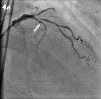 Singapore Med J 20; 52() 6 r 4b t k Fig 4 Coronary angiograms show (a) an occluded (arrow) mid left anterior coronary artery (LAD); (b) immediate postpercutaneous coronary stenting of the LAD, with