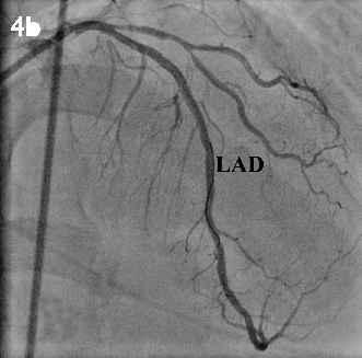 indicator of STEMI as opposed to the other causes of ST elevation () The LAD and RCA are the two most common culprit arteries in STEMI Less commonly, the left circumflex artery (LCx) and rarely, the