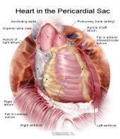 Introduction postmyocardial infarction syndrome
