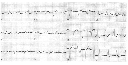 LBBB with