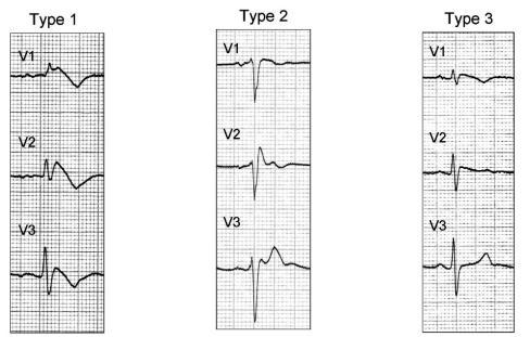 Brugada Syndrome LBBB Infarction Resemblance ST