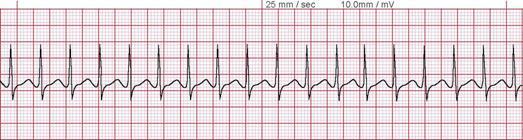 Acute Pericarditis T wave flattening or inversion no T wave inversion during