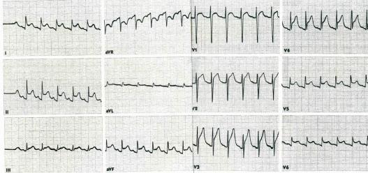which usually have negative T waves (avr & V 1 ) Acute Pericarditis Atrial