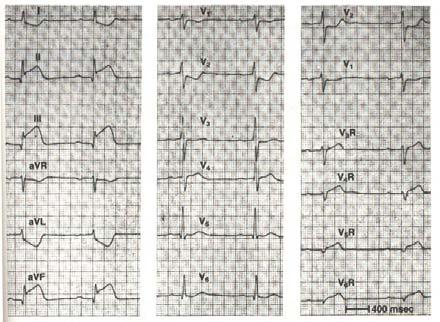 AHA/ACCF/HRS Recommendations for the Standardization and Interpretation of the Electrocardiogram: Ischemia and Infarction 103