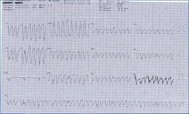 First Look First three questions to ask with every EKG: Is it fast or slow? Is it regular or irregular? Are there P waves yes or no?