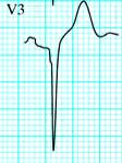 Pathological Q wave Indicate a loss of viable myocardium May develop 1 to 2 hours after the onset of symptoms but can take anywhere from 12 to 24 hours to develop Abnormal Q waves are at greater then